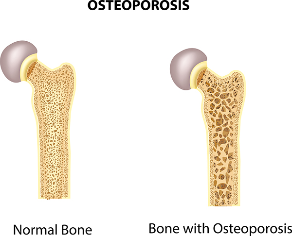 bone comparison