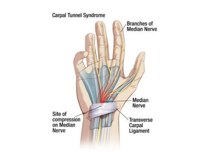 pinched nerve numbness in arm