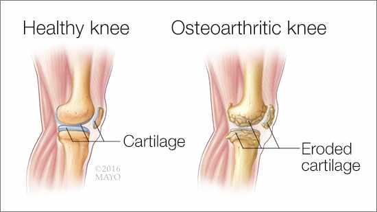 Is It Safe to Exercise With Osteoarthritis? - Sheltering Arms®